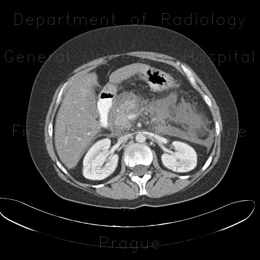 Acute pancreatitis