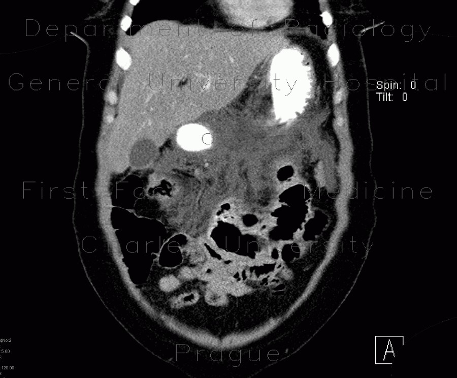 Radiology image - Acute pancreatitis, chylous pancreatitis, hypertriglyceridemia-associated acute pancreatitis: Abdomen, Pancreas, Peritoneal cavity: CT - Computed tomography