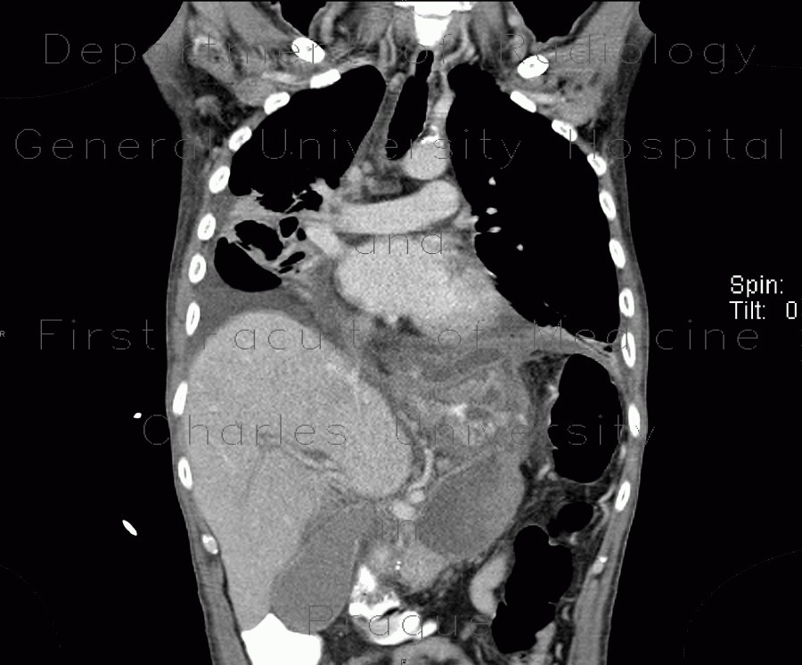 Acute pancreatitis, mediastinitis