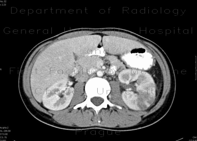 Acute pyelonephritis, left kidney