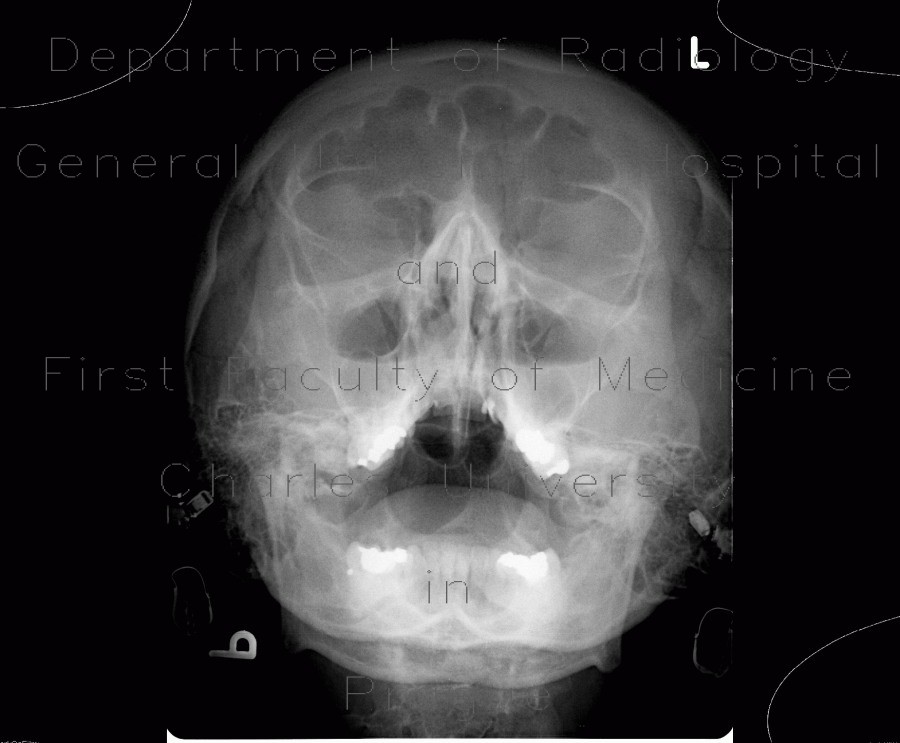 Acute sinusitis