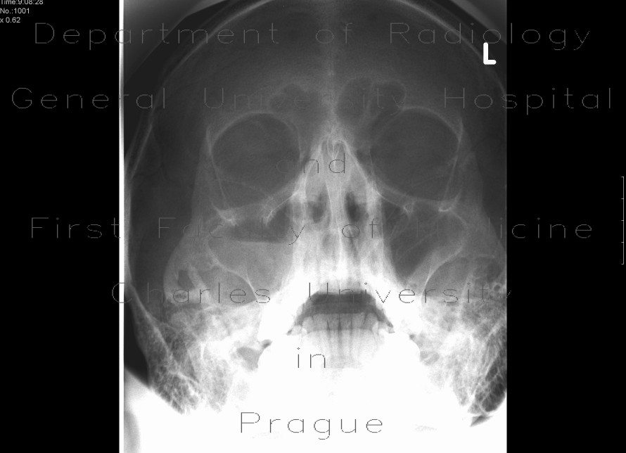 Acute sinusitis, maxillary sinus