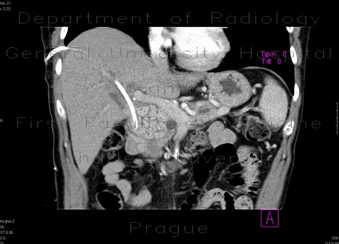 Adenocarcinoma of biliary duct