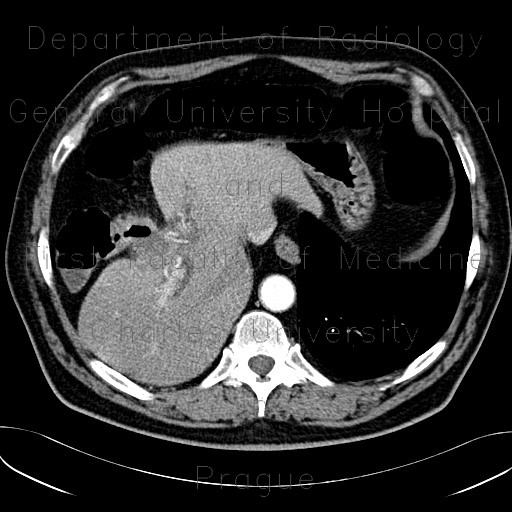 Radiology image - Adenocarcinoma of gallbladder, fistula to colon: Abdomen, Biliary tree, Large bowel: CT - Computed tomography