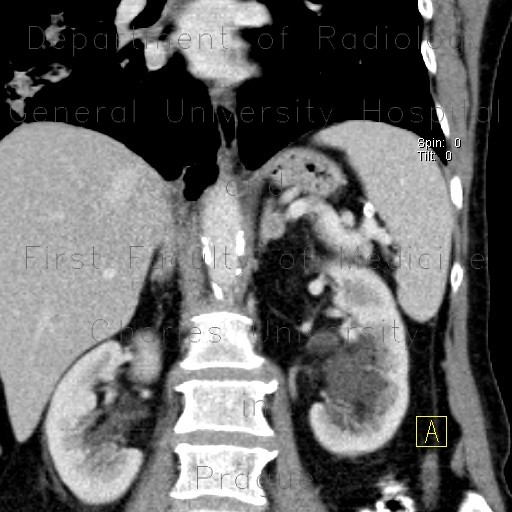 Radiology image - Adenoma of adrenal gland: Abdomen, Kidney and adrenals: CT - Computed tomography
