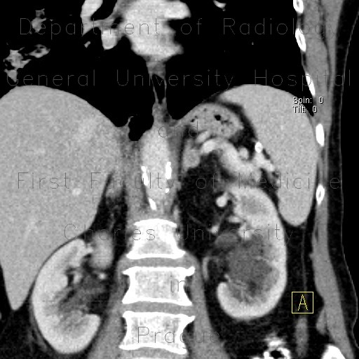 Adenoma of adrenal gland