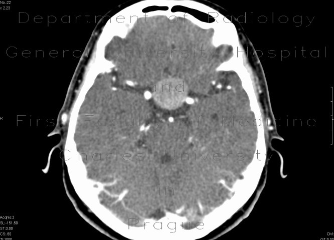 Radiology image - Adenoma of hypophysis, before and after resection: Brain, Brain: CT - Computed tomography