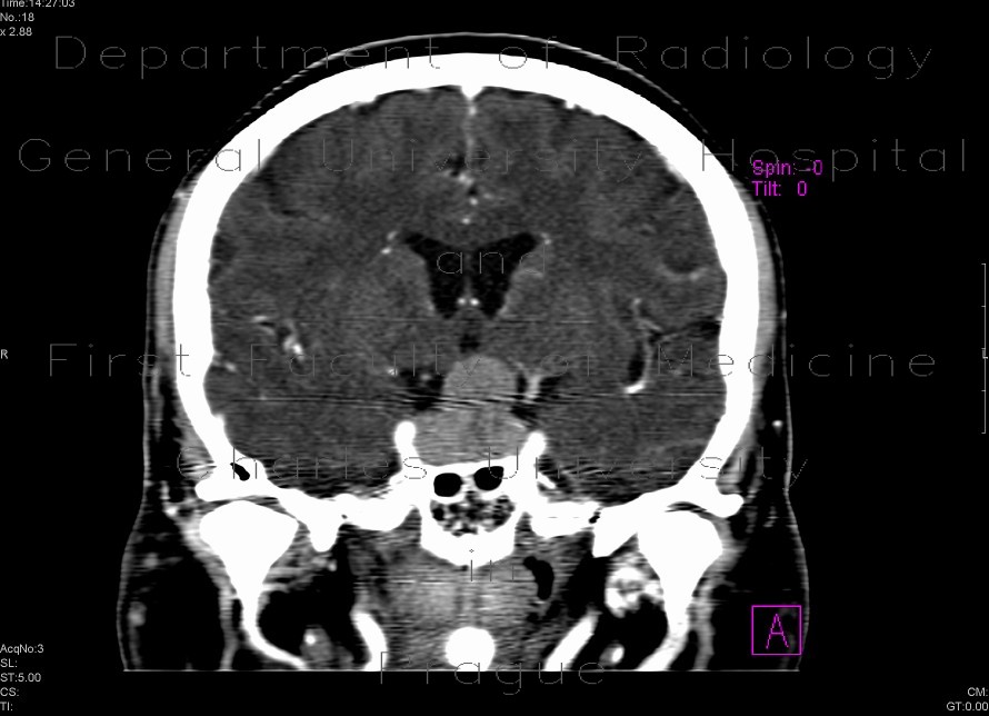 Radiology image - Adenoma of the hypophysis: Brain, Brain: CT - Computed tomography