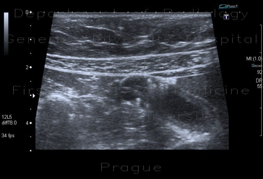 Adenomyosis of gallbladder, localized