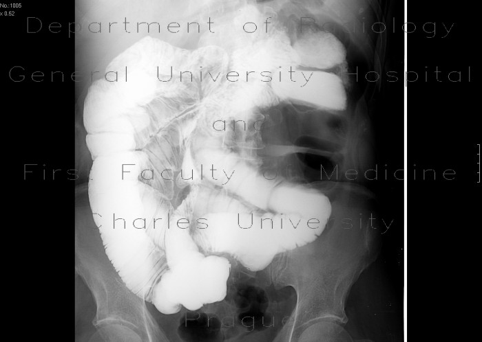 Radiology image - Adhesions, enteroclysis: Abdomen, Small bowel: RF - Fluoroscopy