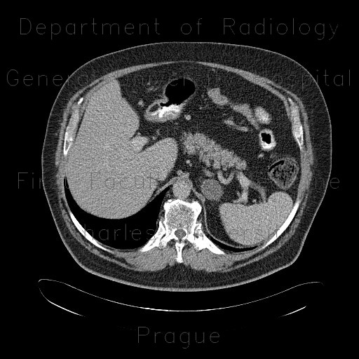 Adrenal adenoma, adenoma of adrenal gland