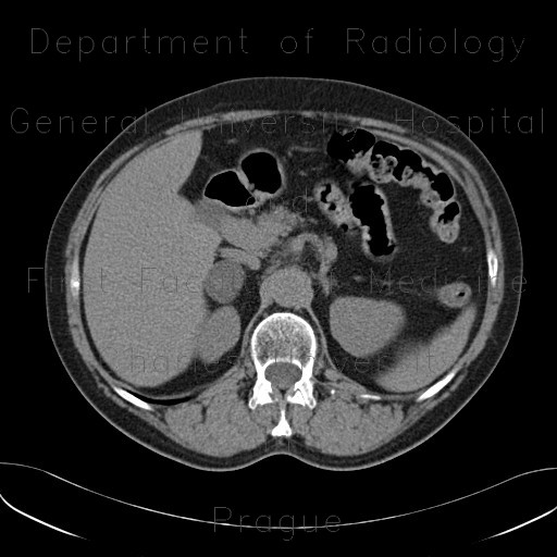 Radiology image - Adrenal adenoma, unenhanced: Abdomen, Kidney and adrenals: CT - Computed tomography