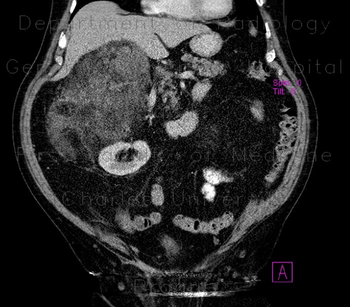 Adrenal myelolipoma