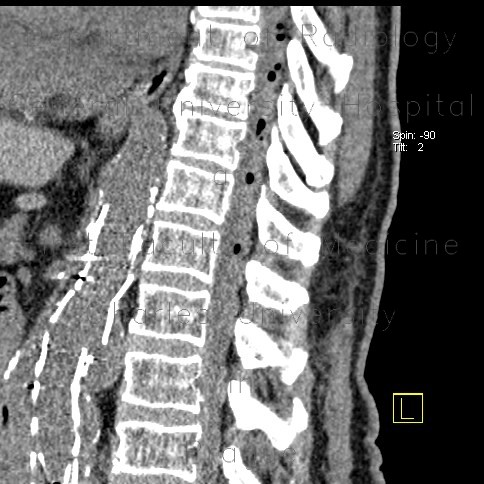 Air bubbles in spinal canal after stentgraft placement and spinal anesthesia, spinal paraparesis