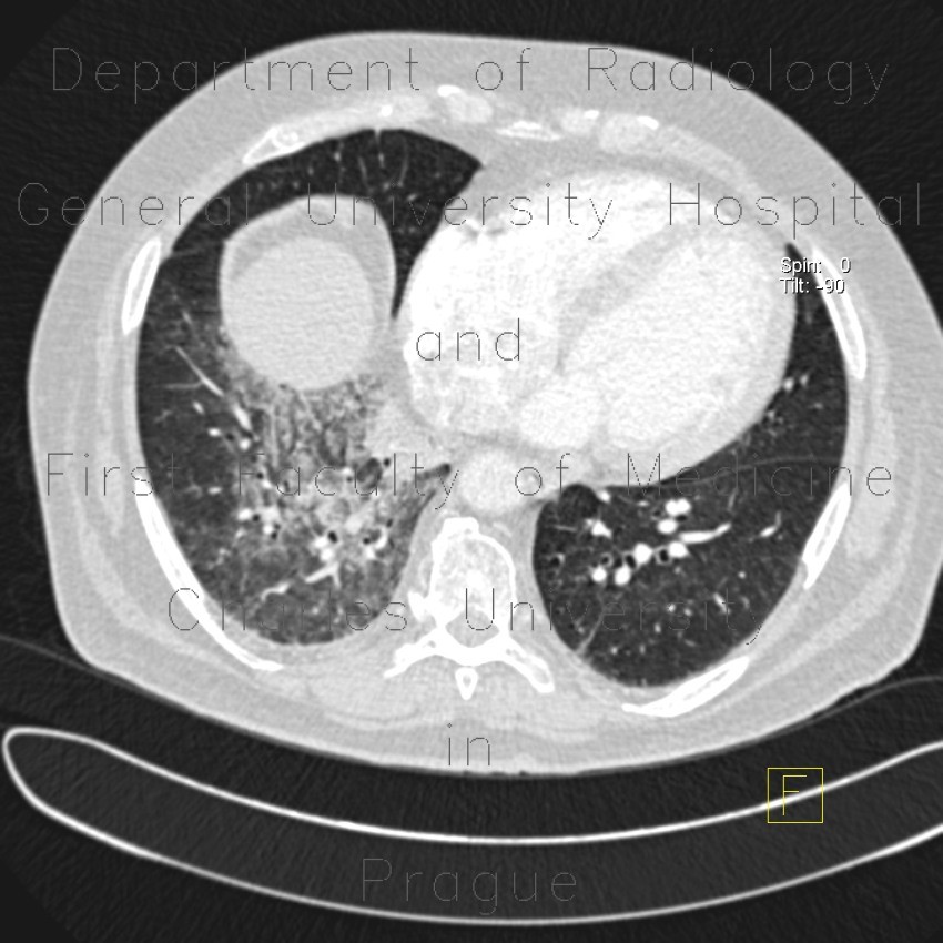 Radiology image - Alveolar hemorrhage: Thorax, Lung: CT - Computed tomography