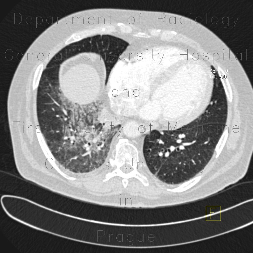 Alveolar hemorrhage