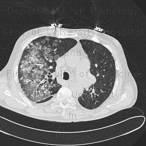 Alveolar hemorrhage, acute stage