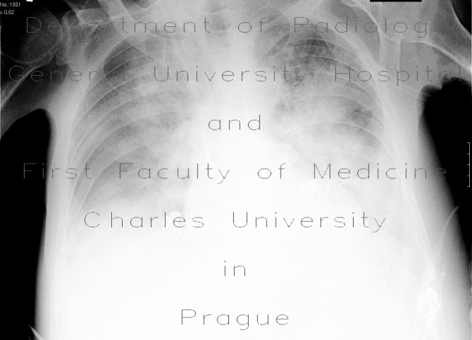 Alveolar lung edema