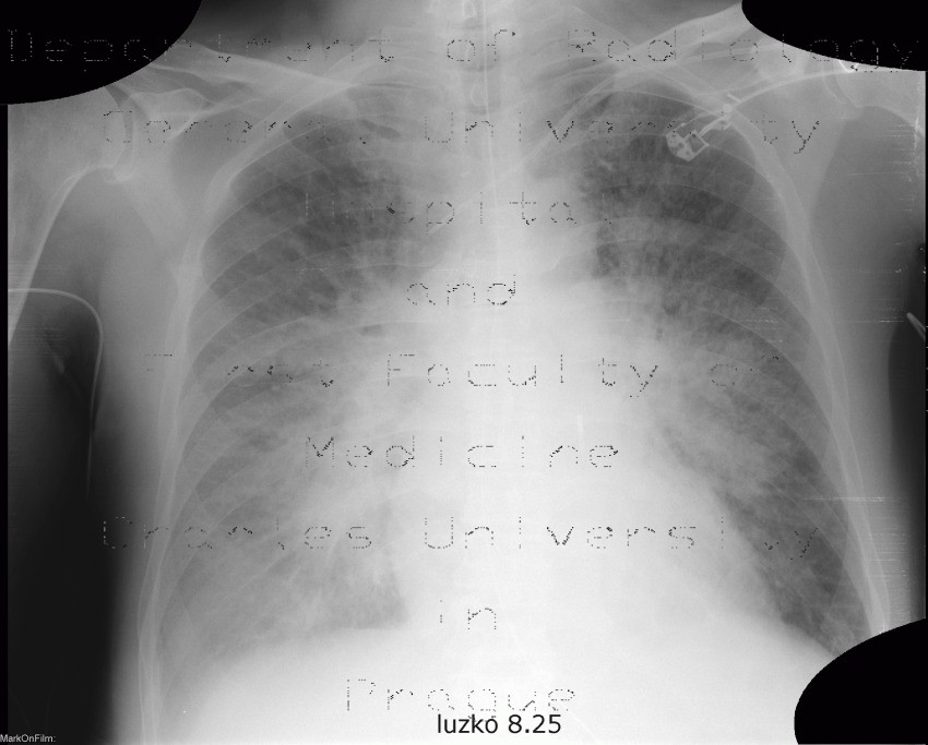Radiology image - Alveolar lung edema: Thorax, Lung: X-ray - Plain radiograph