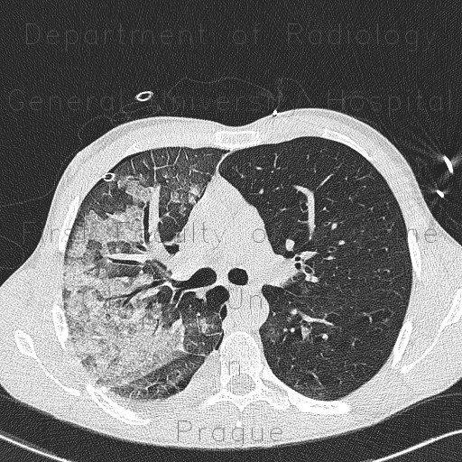 Radiology image - Alveolar lung edema, unilateral: Thorax, Lung: CT - Computed tomography