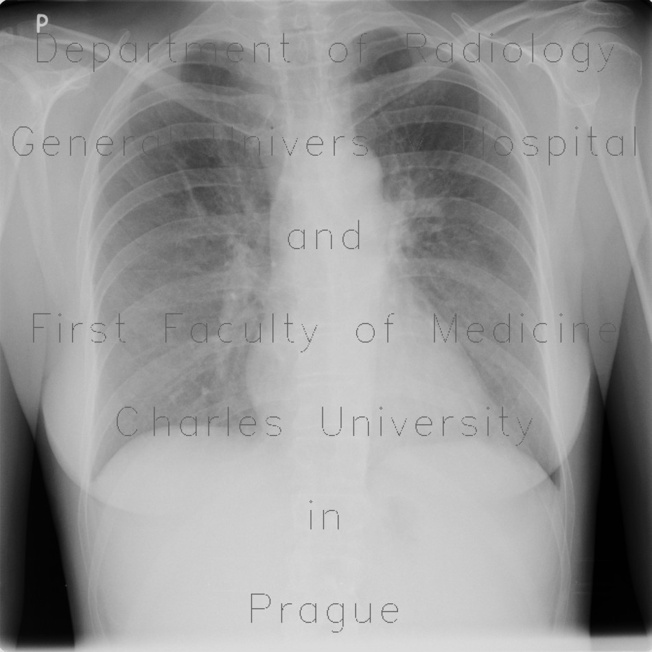 Alveolar pattern, HRCT