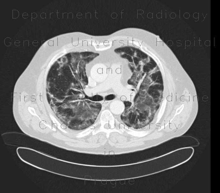 Radiology image - Amiodarone lung, toxic pneumonitis: Thorax, Lung: CT - Computed tomography