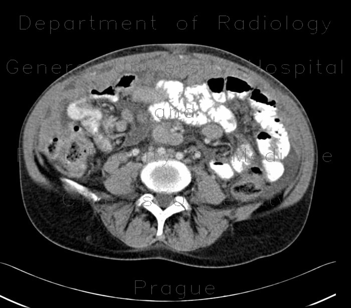 Anaplastic lymphoma in peritoneal cavity, retroperitoneal and mesenterial lymphadenopathy