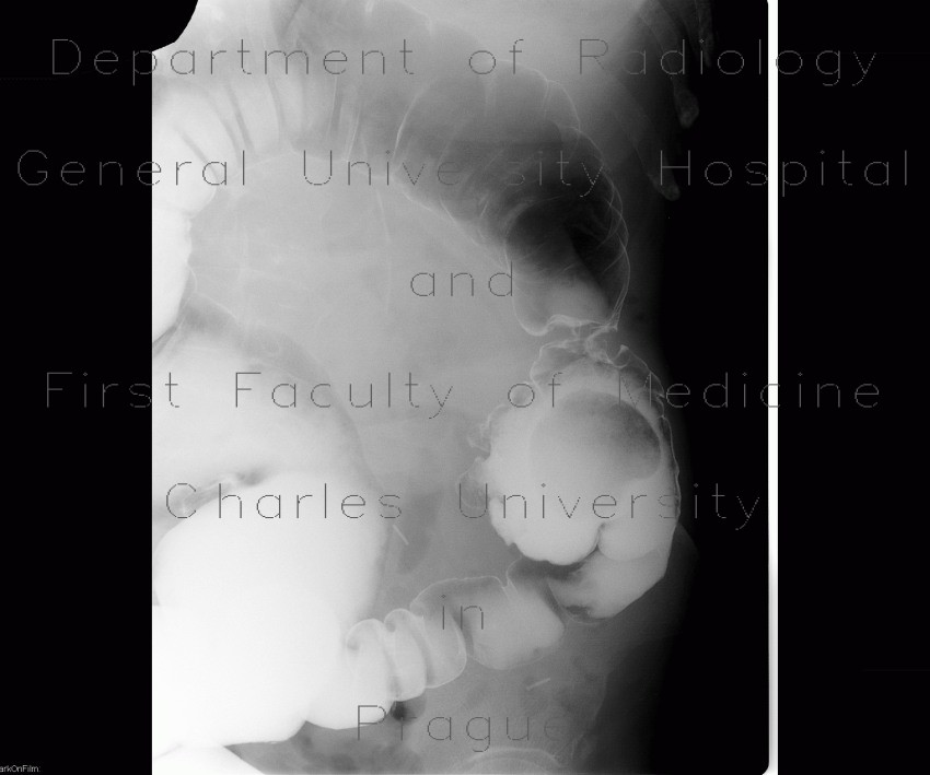 Anastomosis of large bowel on barium enema