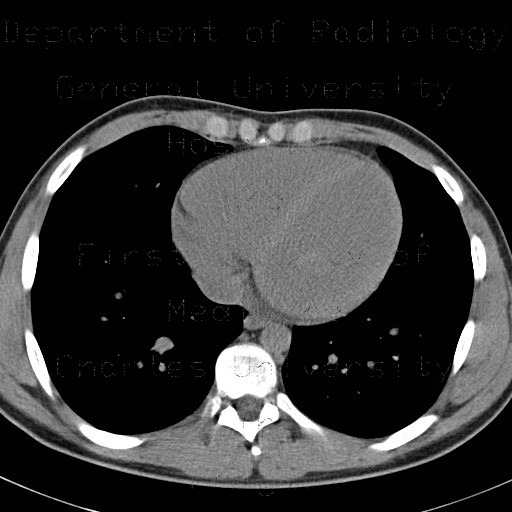 Radiology image - Anemia, heart: Thorax, Heart, Other: CT - Computed tomography