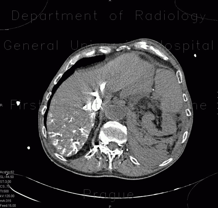 Aneurysm of abdominal aorta, AAA, ruptured, cardiac arrest, deceased