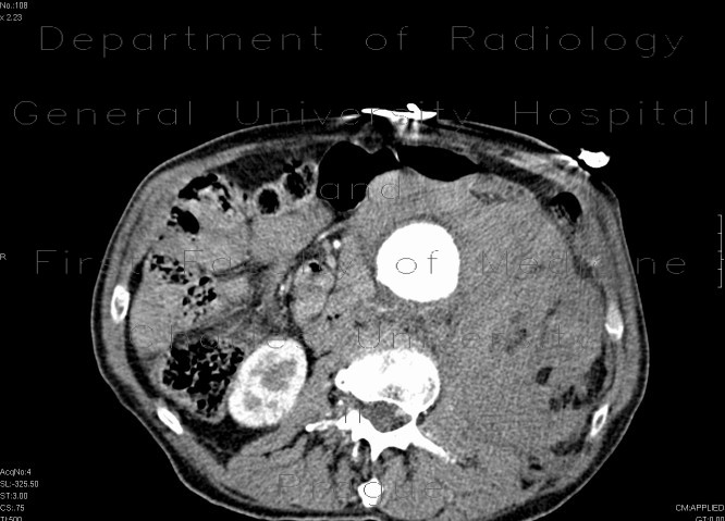 Radiology image - Aneurysm of abdominal aorta, AAA, ruptured, retroperitoneal bleeding: Abdomen, Retroperitoneum, pelvis, Vessels: CT - Computed tomography