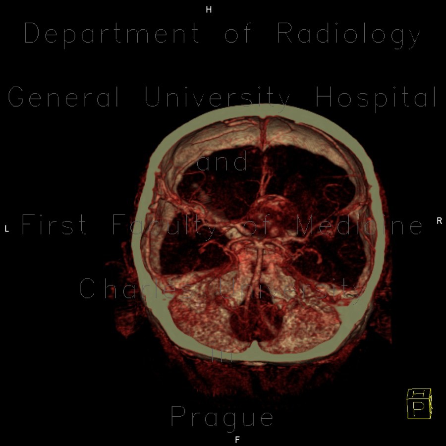 Radiology image - Aneurysm of internal carotid artery, left: Brain, Brain, Vessels: CT - Computed tomography