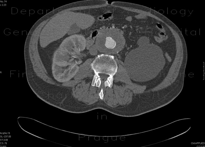 Radiology image - Aneurysm of the abdominal aorta, AAA, aorto-iliac stentgraft: Abdomen, Vessels: CT - Computed tomography