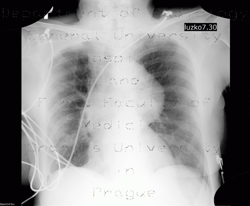 Radiology image - Aneurysm of thoracic aora: Thorax, Mediastinum and pleural cavity, Vessels: X-ray - Plain radiograph