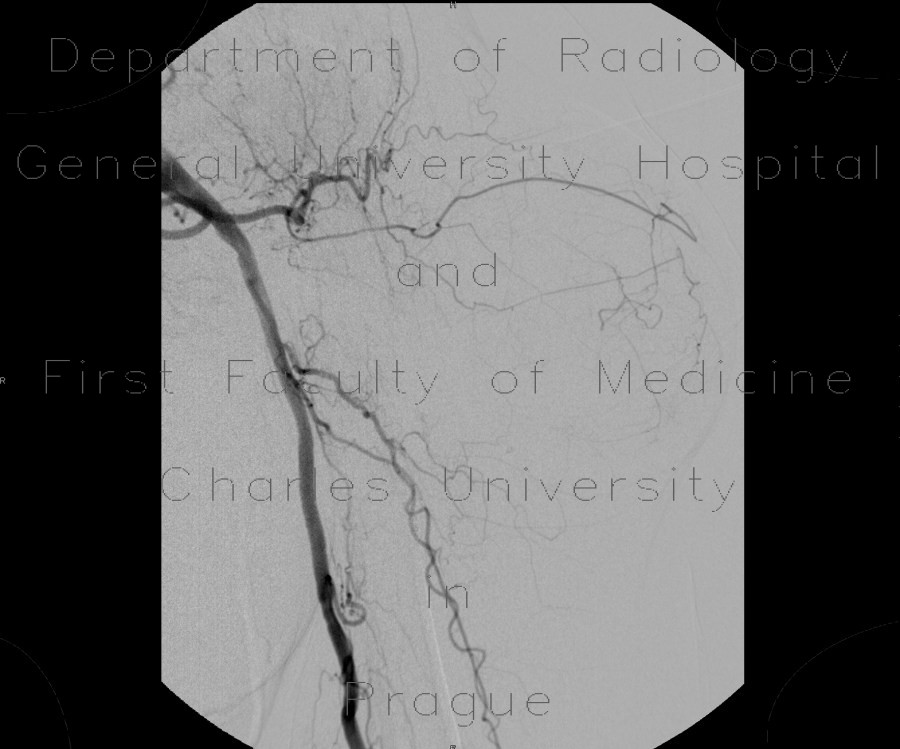 Radiology image - Angiography of lipoma, arm, thoracoacromial artery, preoperative, DSA: Extremity, Soft tissue: AG - Angiography