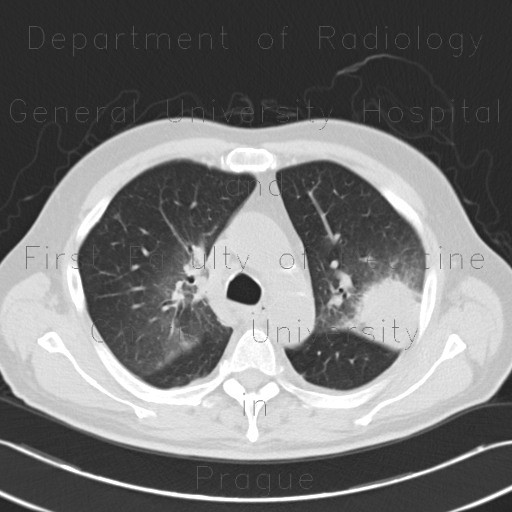 Radiology image - Angioinvasive aspergilosis: Thorax, Lung: CT - Computed tomography