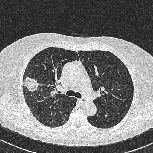 Angioinvasive aspergilosis, last CT