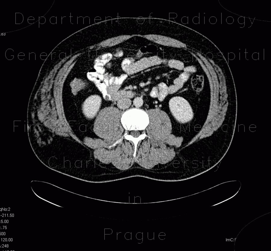 Radiology image - Angiolipoma, subcutaneous, selective embolisation: Abdomen, Soft tissue, Vessels: CT - Computed tomography