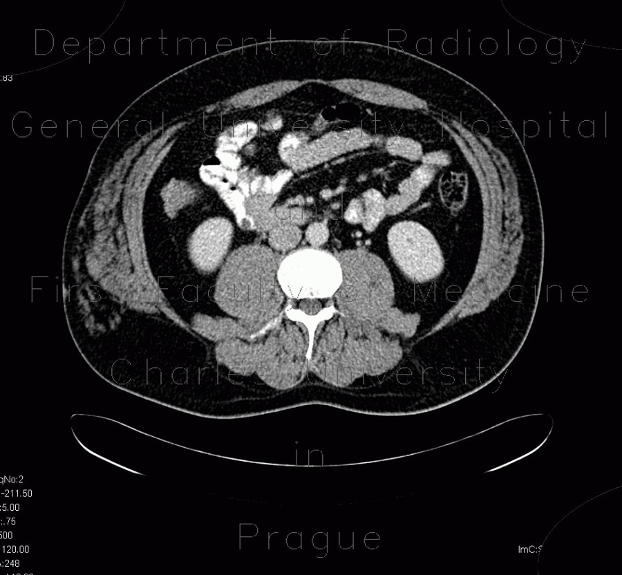 Angiolipoma, subcutaneous, selective embolisation