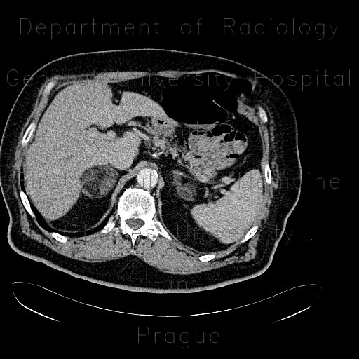 Radiology image - Angiomyolipoma, adenoma, adrenal adenoma, multiple: Abdomen, Kidney and adrenals: CT - Computed tomography