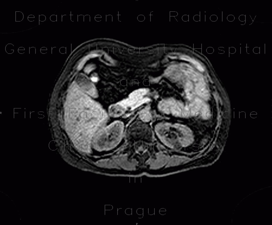 Angiomyolipoma of kidney, atypical