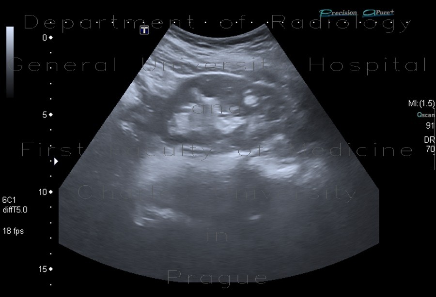 Radiology image - Angiomyolipoma of kidney, renal angiomyolipoma: Abdomen, Kidney and adrenals: US - Ultrasound