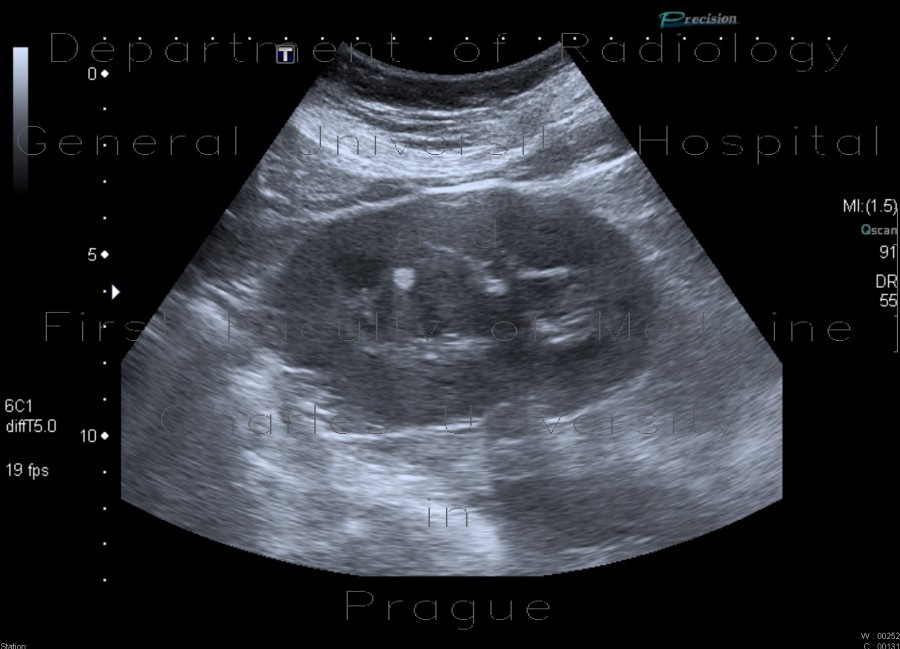 Angiomyolipoma, renal, bilateral