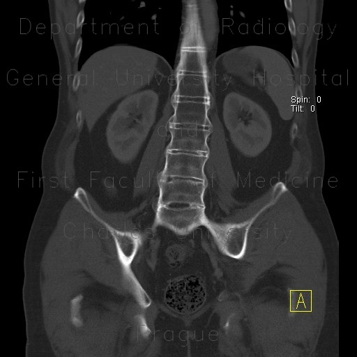 Radiology image - Ankylosing spondylitis, Bechterew