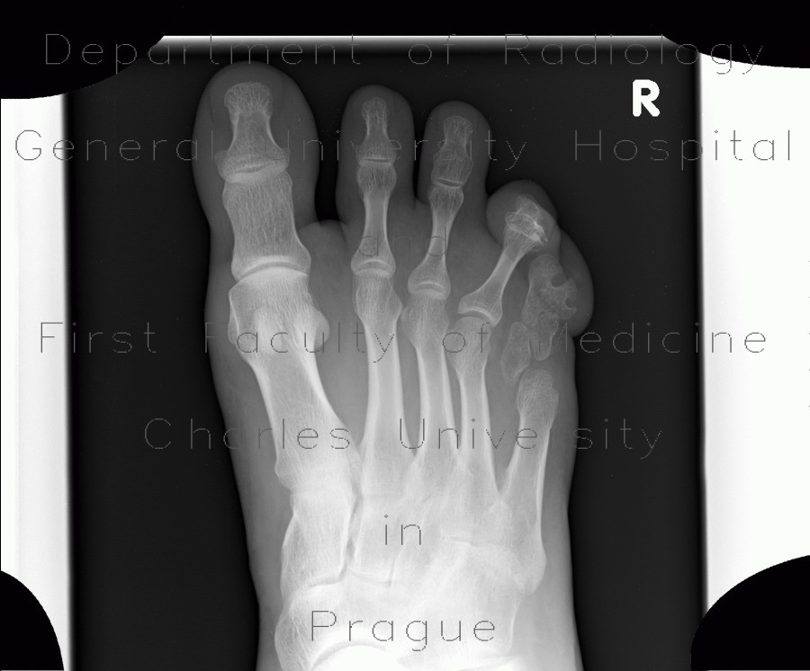 Anomally of the little finger of the foot, congenital