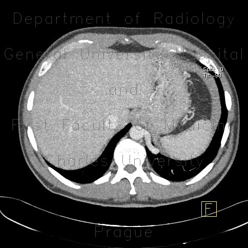 Radiology image - Anomalous blood supply from systemic circulation in left lower lung lobe: Thorax, Vessels: CT - Computed tomography