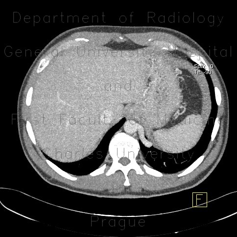 Anomalous blood supply from systemic circulation in left lower lung lobe