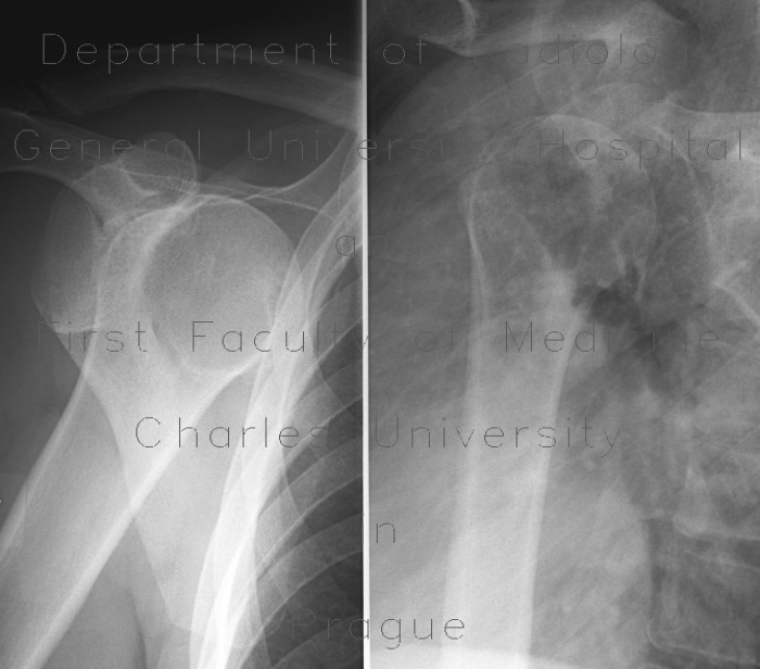 Radiology image - Anterior dislocation of shoulder: Extremity, Bone: X-ray - Plain radiograph