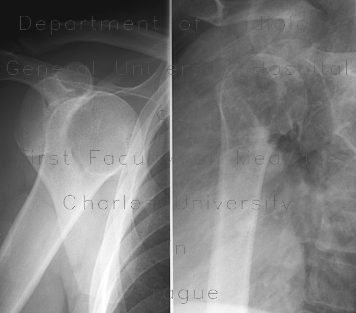 Anterior dislocation of shoulder