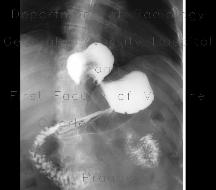 Radiology image - Antireflux plastic, fundoplication, Nissen, slipped above the diaphraghm: Abdomen, Thorax, Oesophagus, Stomach: RF - Fluoroscopy